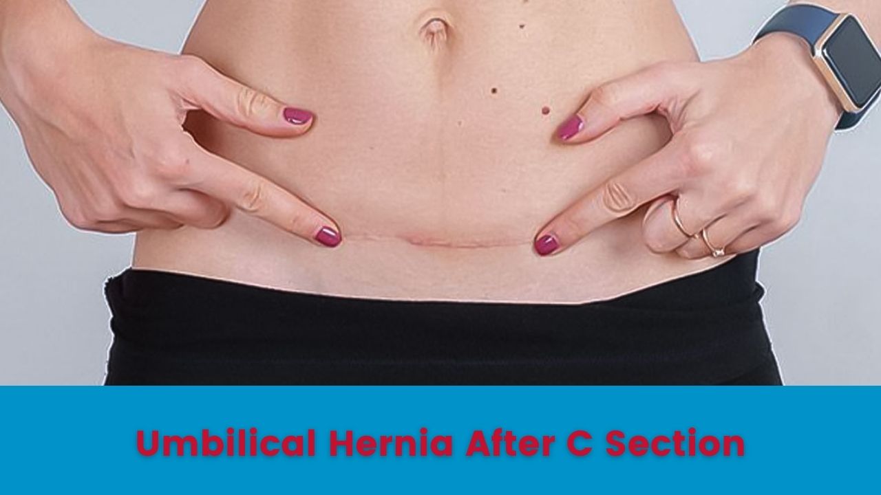 Umbilical hernia or postpartum hernia is a condition that can develop among women who had a C-section delivery. However, there are several reasons why a doctor recommends a caesarean delivery.