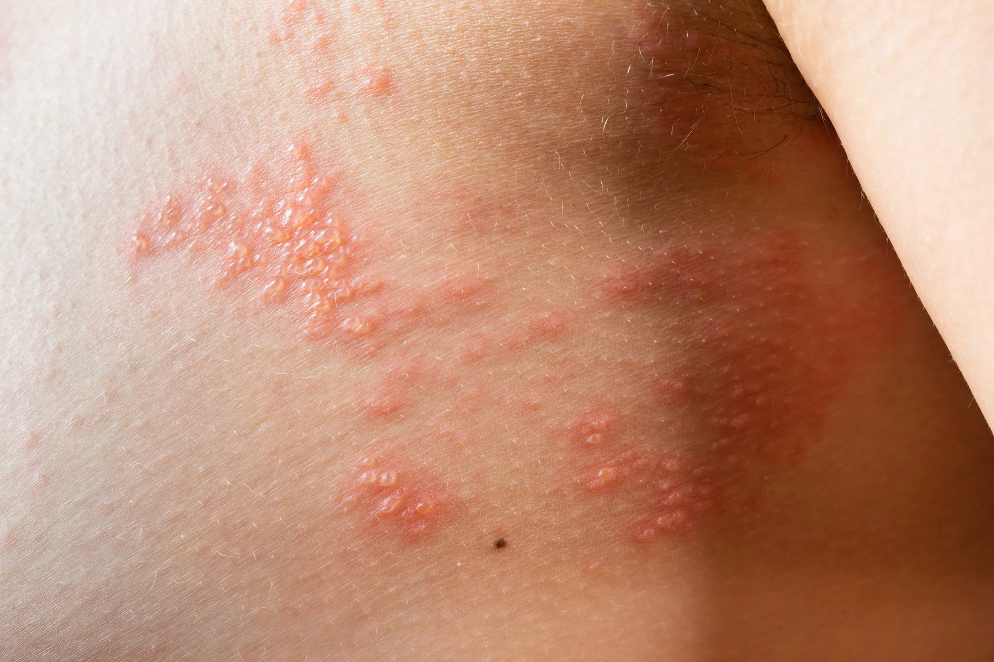 Shingles Rash Early Stages