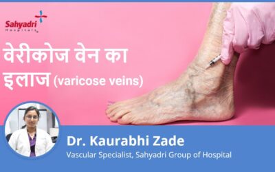 What is the Treatment and Prevention of Varicose Veins?