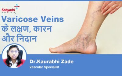 What is Varicose veins? (Hindi)