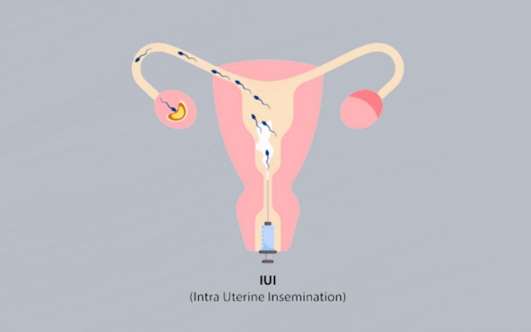 What is Intrauterine Insemination (IUI)?
