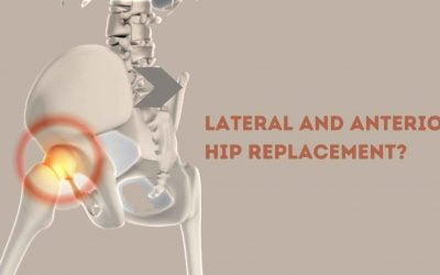 What Is the Difference Between Lateral and Anterior Hip Replacement?