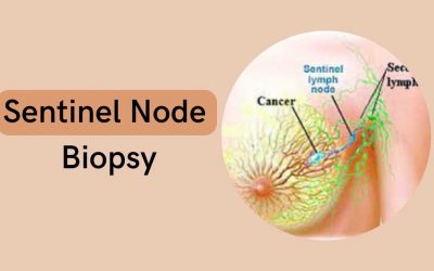 Sentinel Node Biopsy
