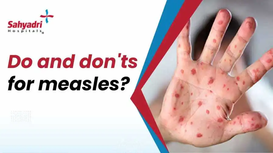 Do and don'ts for measles