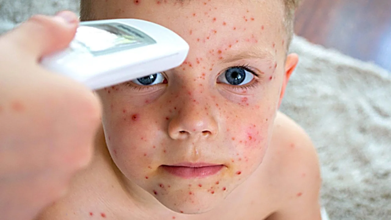 measles rash face