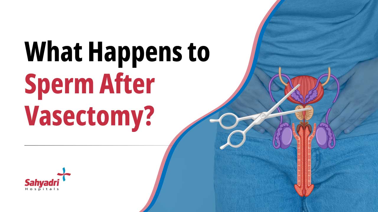 What Happens To Sperm After Vasectomy Sahyadri Hospital Sahyadri Hospital 